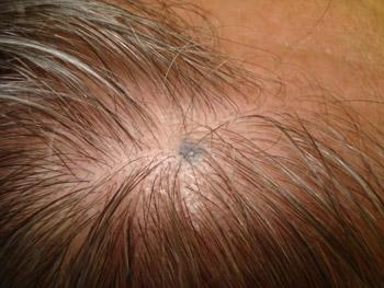 Родимое пятно или родинка на голове в волосах — что означает